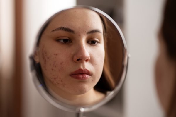 Marcas de Acne: Quais Ácidos Usar e Como